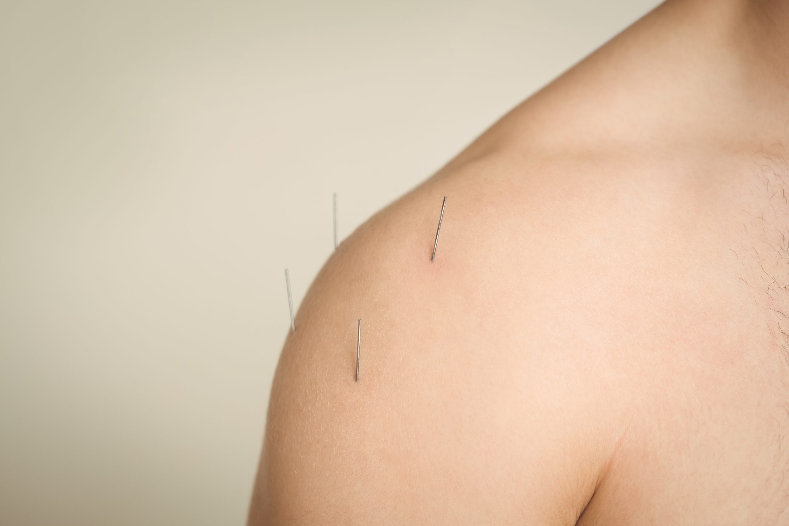 Afecțiuni tratate prin dry needling – dureri musculare, contracturi, rigiditate