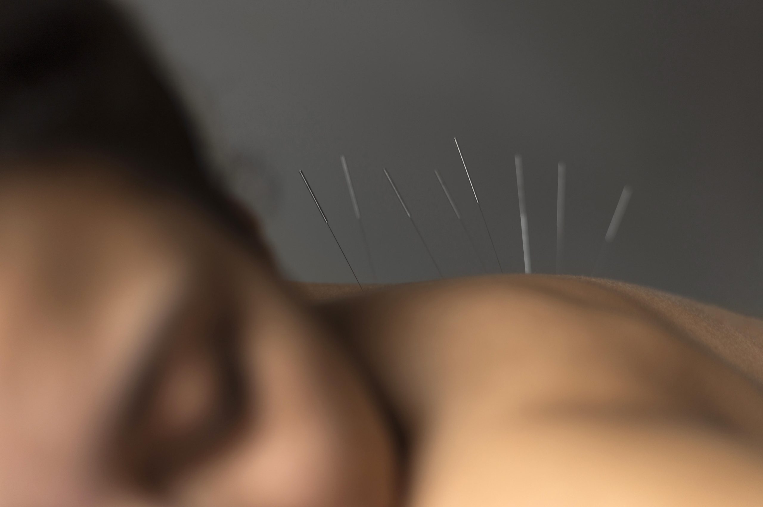 Beneficiile terapiei Dry Needling pentru dureri musculare – Arra Medical Center Iași