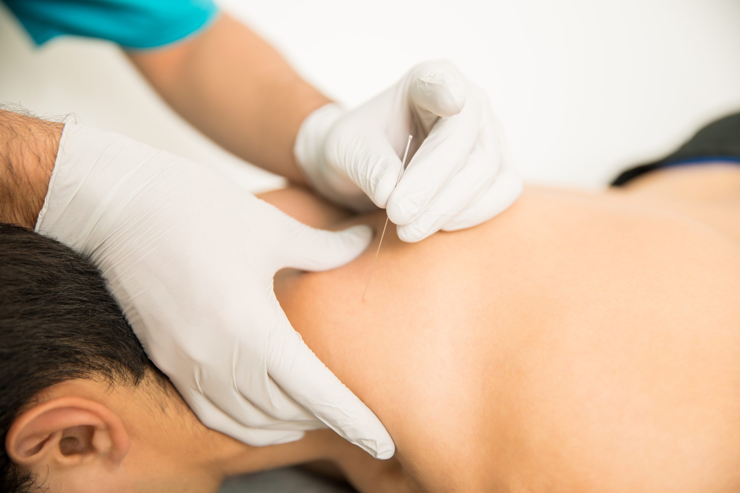 Cum decurge o ședință de dry needling la Arra Medical Center Iași