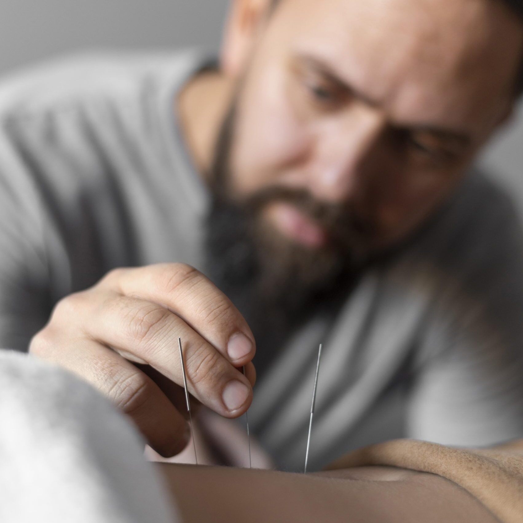 Când este recomandată terapia Dry Needling – Arra Medical Center Iași